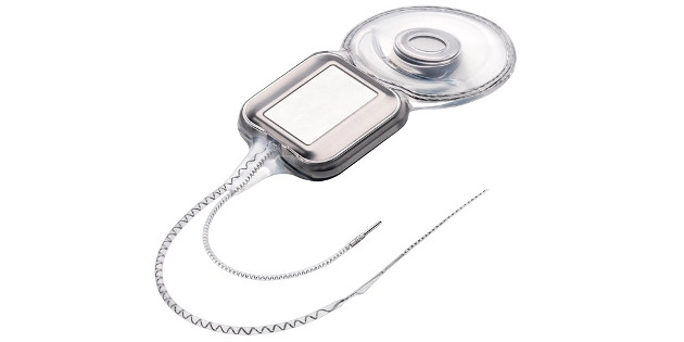 L&rsquo;implant CI522 de Cochlear sur la liste des produits remboursés